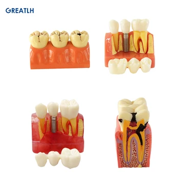 Dentare 4Times Cariilor Demontarea Model de Implant Model Dentare Demonstrație Dinți Model